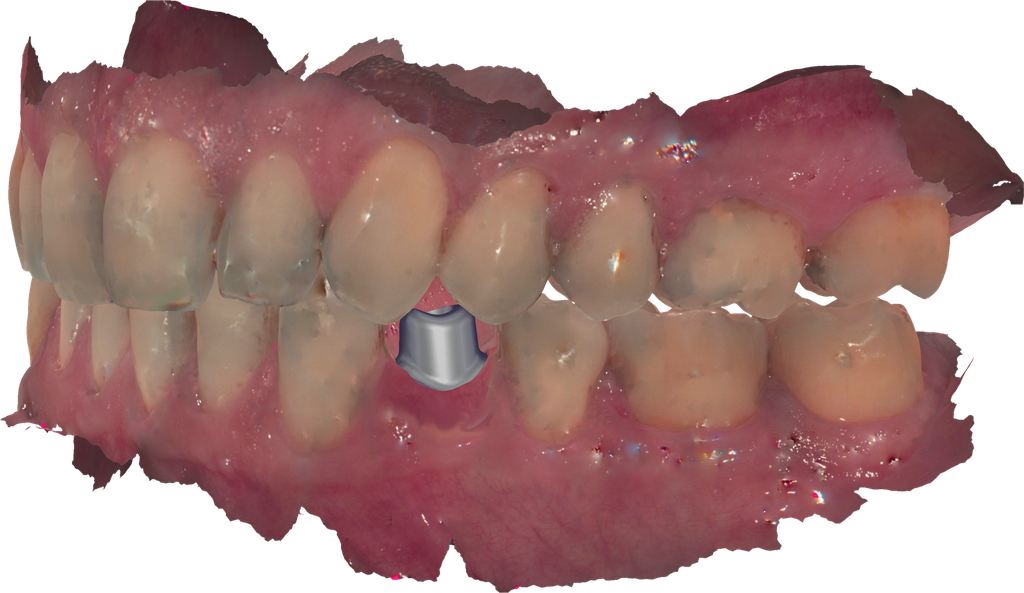 ChairsideCAD Implant Module
