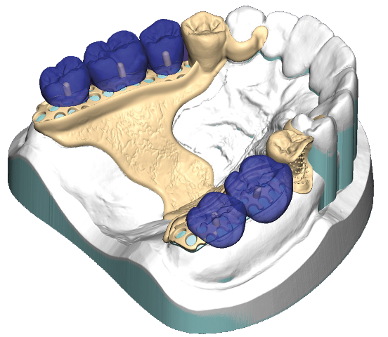 Exocad PartialCAD Module Stand Alone