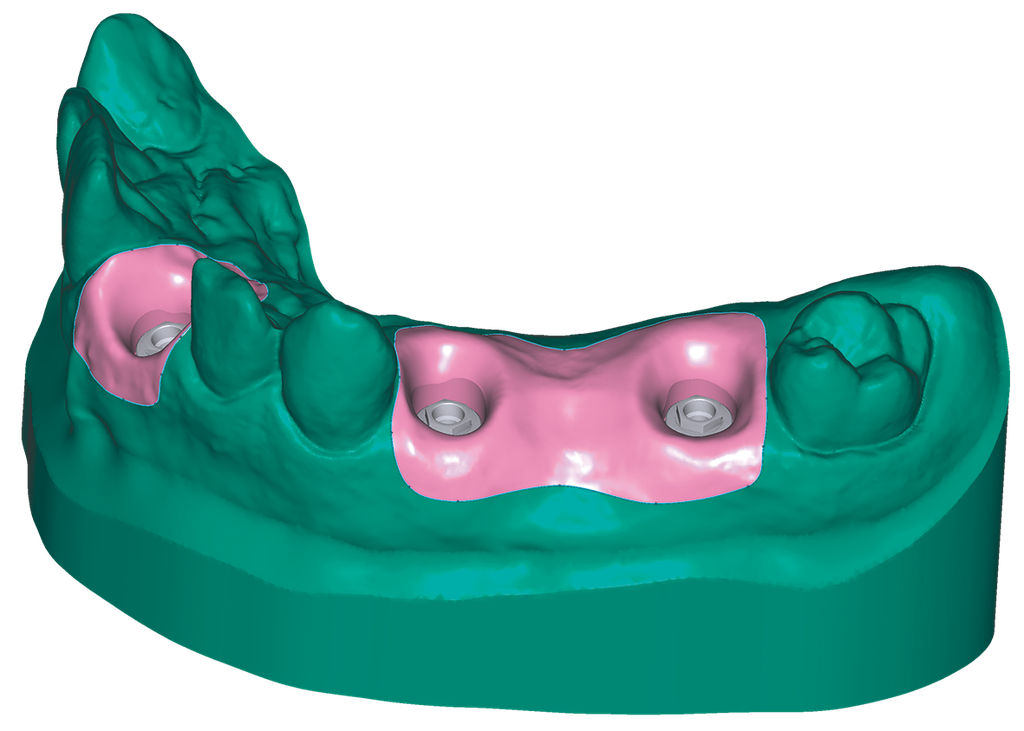 Exocad Model Creator with Implant Analogs for Model Creator Stand Alone