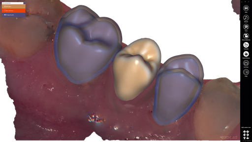 [SW-CC-10] ChairsideCAD Provisional Module