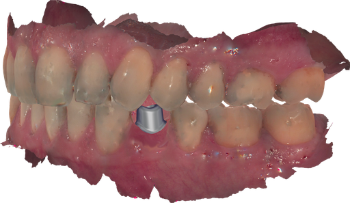 [SW-CC-2] ChairsideCAD Implant Module